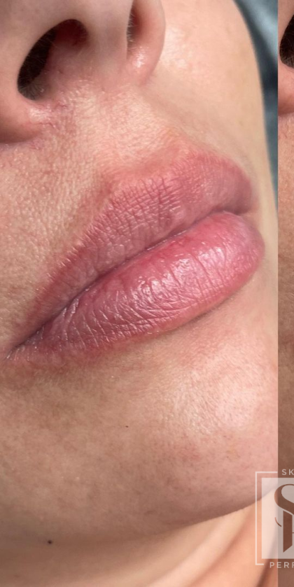 Lip Enhancement Before & After Patient #11971