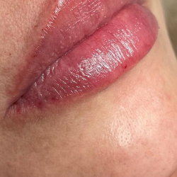 Lip Enhancement Before & After Patient #11971