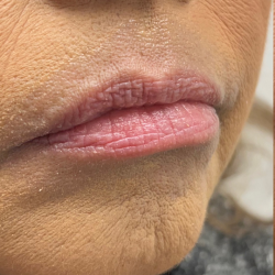 Lip Enhancement Before & After Patient #11972