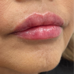 Lip Enhancement Before & After Patient #11972
