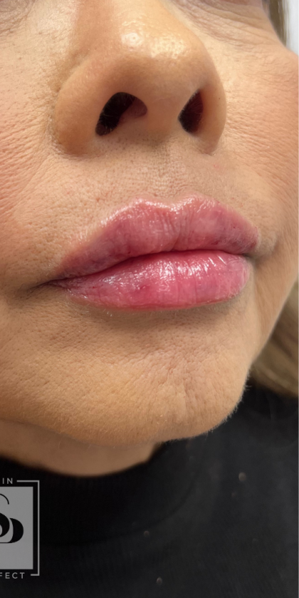 Lip Enhancement Before & After Patient #11972