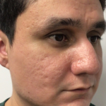 Acne + Pigmentation Correction Before & After Patient #12037