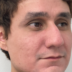 Acne + Pigmentation Correction Before & After Patient #12037