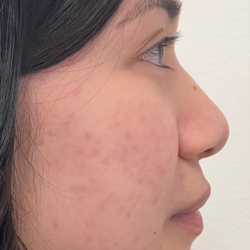 Non-surgical Nose Job Before & After Patient #12000