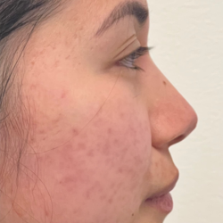 Non-surgical Nose Job Before & After Patient #12000