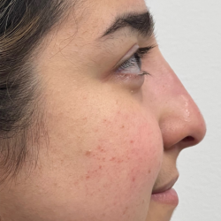 Non-surgical Nose Job Before & After Patient #12001