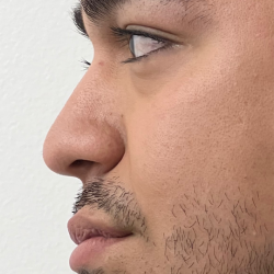 Non-surgical Nose Job Before & After Patient #12002