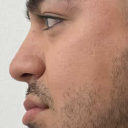 Non-surgical Nose Job Before & After Patient #12002