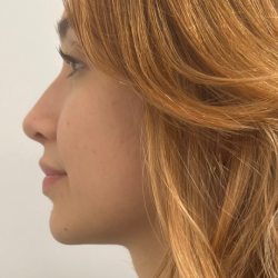 Non-surgical Nose Job Before & After Patient #12003