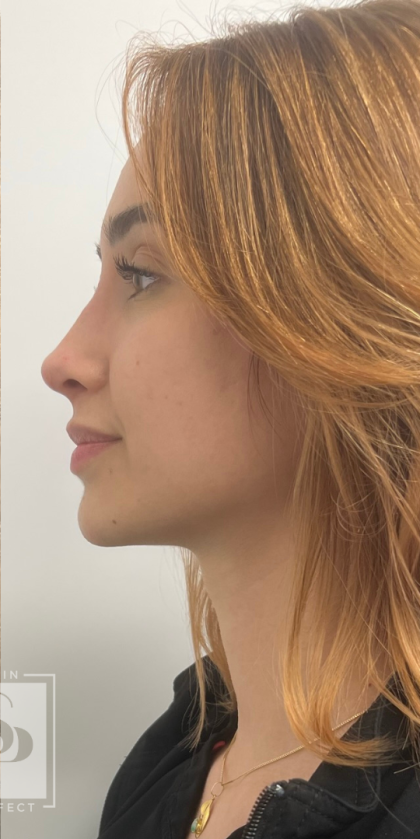 Non-surgical Nose Job Before & After Patient #12003