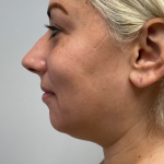 Chin Enhancement Before & After Patient #12023