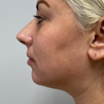 Chin Enhancement Before & After Patient #12023
