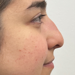 Non-surgical Nose Job Before & After Patient #12005
