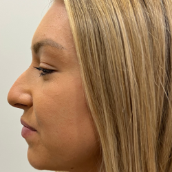Lip Enhancement Before & After Patient #11973