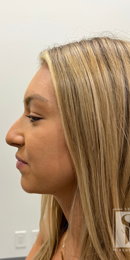 Non-surgical Nose Job Before & After Patient #12006