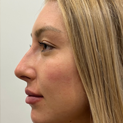 Lip Enhancement Before & After Patient #11973