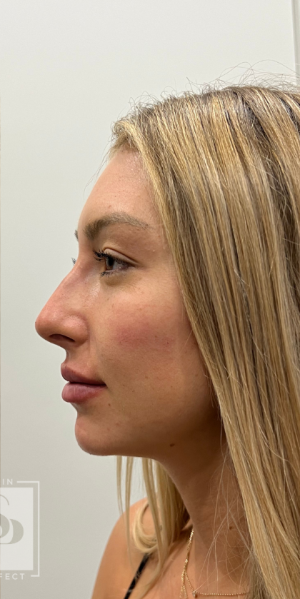 Lip Enhancement Before & After Patient #11973