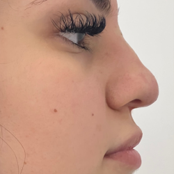 Non-surgical Nose Job Before & After Patient #12007