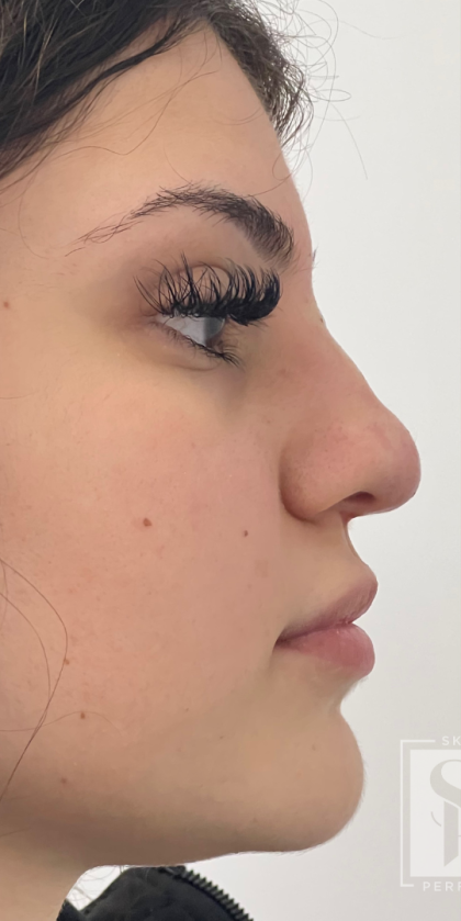 Non-surgical Nose Job Before & After Patient #12007