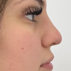 Non-surgical Nose Job Before & After Patient #12007