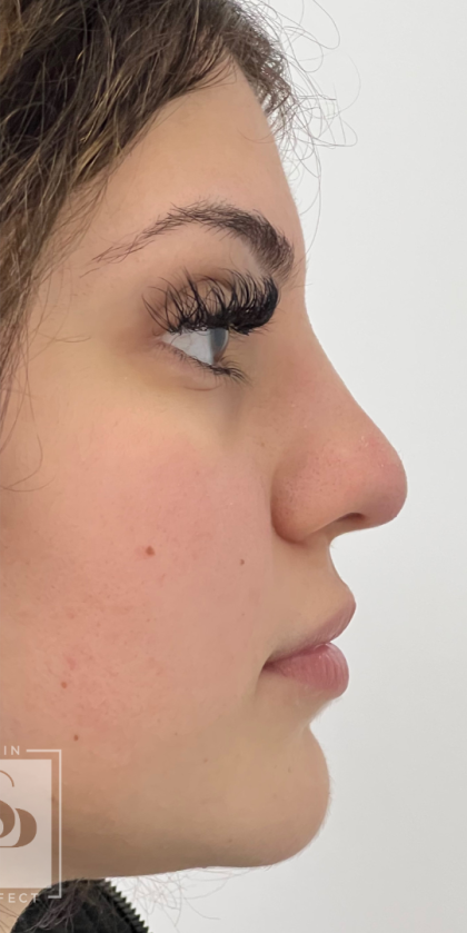 Non-surgical Nose Job Before & After Patient #12007