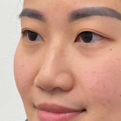 Non-surgical Nose Job Before & After Patient #12008