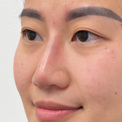 Non-surgical Nose Job Before & After Patient #12008