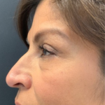 Non-surgical Nose Job Before & After Patient #12009