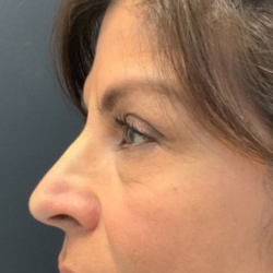 Non-surgical Nose Job Before & After Patient #12009