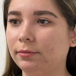Cheek Enhancement Before & After Patient #12013