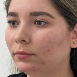 Cheek Enhancement Before & After Patient #12013