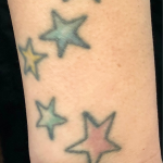 Tattoo Removal Before & After Patient #12041