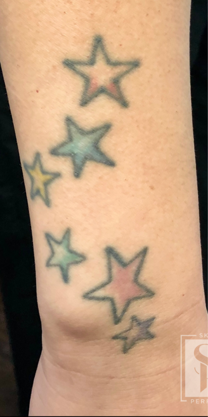 Tattoo Removal Before & After Patient #12041