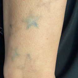 Tattoo Removal Before & After Patient #12041