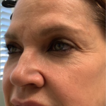 Non-Surgical Facelift Before & After Patient #11979