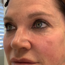 Non-Surgical Facelift Before & After Patient #11979