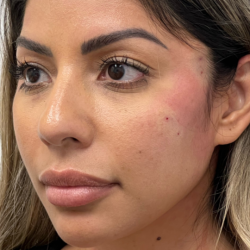 Non-Surgical Facelift Before & After Patient #11980