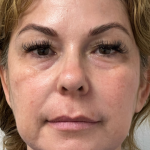 Non-Surgical Facelift Before & After Patient #11981
