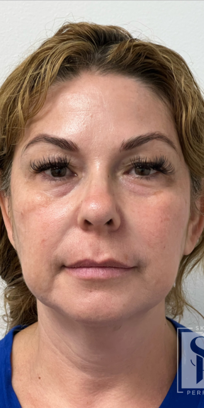 Non-Surgical Facelift Before & After Patient #11981