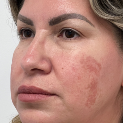 Non-Surgical Facelift Before & After Patient #11982