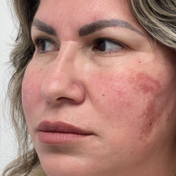Non-Surgical Facelift Before & After Patient #11982