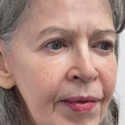 Non-Surgical Facelift Before & After Patient #11983