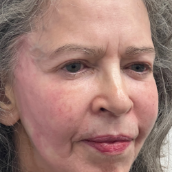 Non-Surgical Facelift Before & After Patient #11983