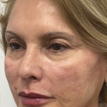 Non-Surgical Facelift Before & After Patient #11985