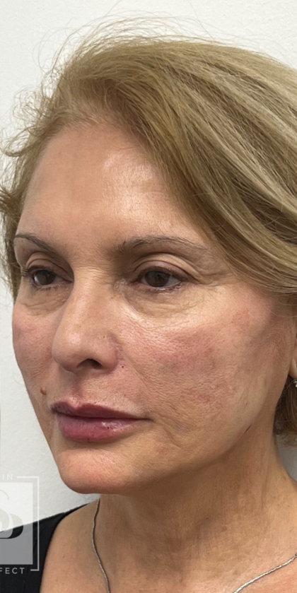 Lip Enhancement Before & After Patient #11974