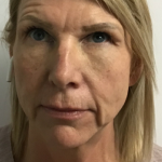 Non-Surgical Facelift Before & After Patient #11986