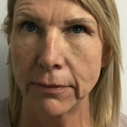 Wrinkle Reduction Before & After Patient #11957