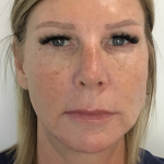Wrinkle Reduction Before & After Patient #11957