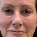 Non-Surgical Facelift Before & After Patient #11984