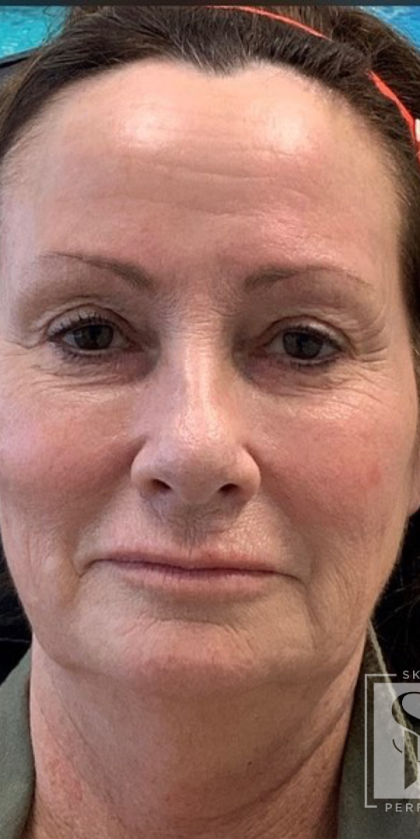 Non-Surgical Facelift Before & After Patient #11984
